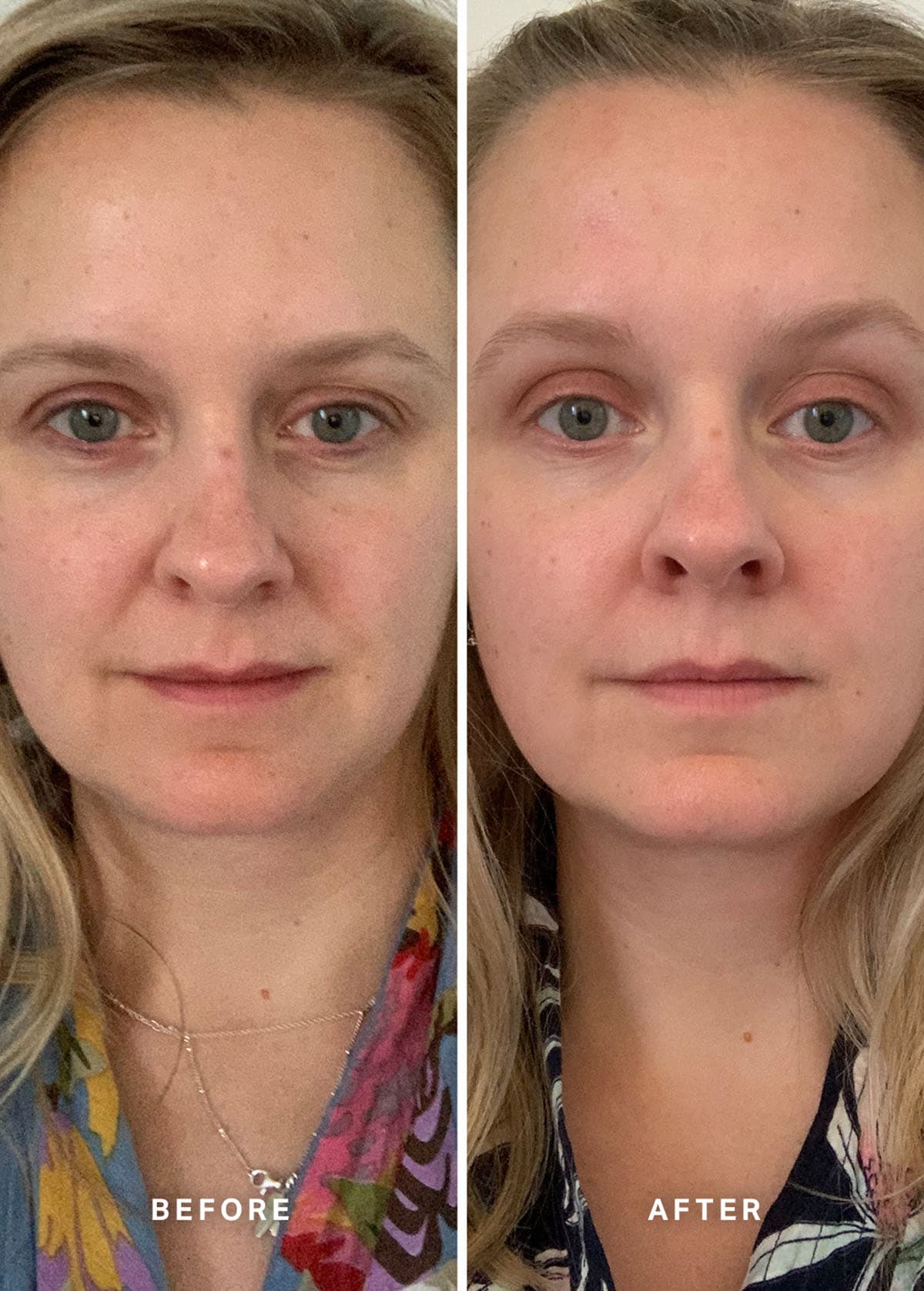 Serum Vitamin A